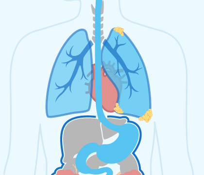 Stage 2 Mesothelioma Illustration