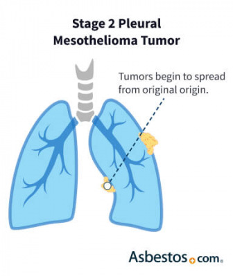 Stage 2 mesothelioma tumor progression