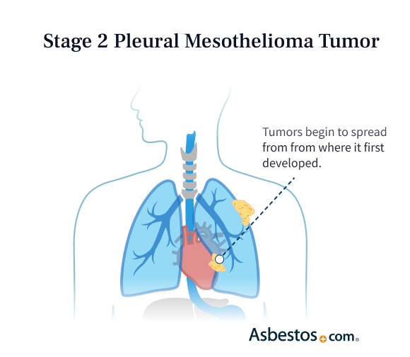 Stage 2 Mesothelioma