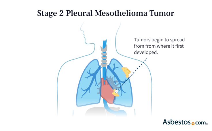 Stage 2 Mesothelioma