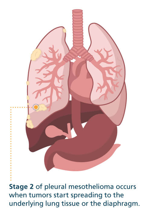 Mesothelioma What is Malignant Mesothelioma Cancer Mesothelioma What is Malignant Mesothelioma Cancer