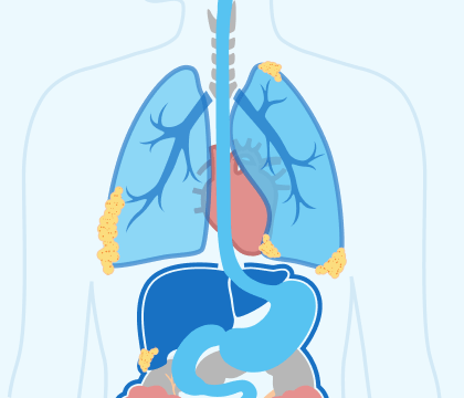 Stage 3 Mesothelioma Illustration