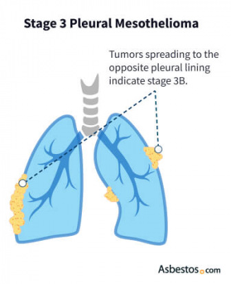 Stage 3 mesothelioma tumor progression