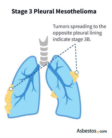 does breast cancer cause heart palpitations