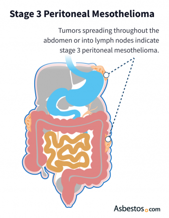 Stage 3 peritoneal mesothelioma tumor progression
