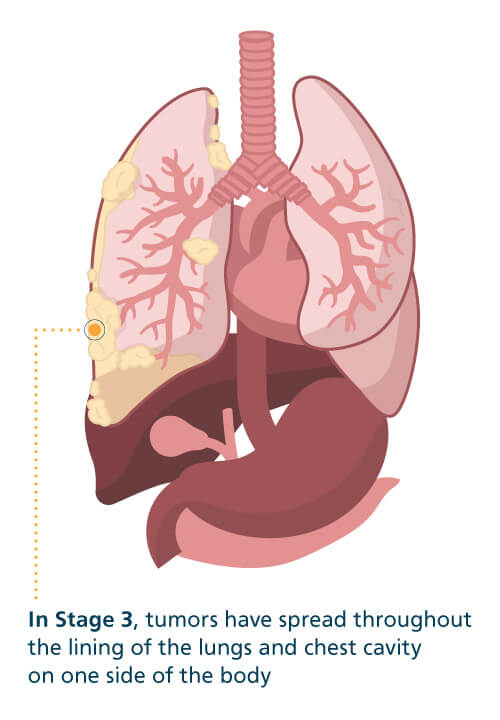 Mesothelioma What is Malignant Mesothelioma Cancer Mesothelioma What is Malignant Mesothelioma Cancer