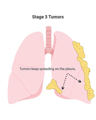Mesothelioma: What Is Malignant Mesothelioma Cancer?