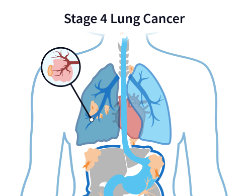 Stage 4 Asbestos-Related Lung Cancer