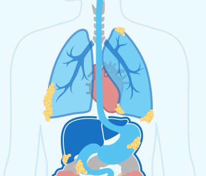 Stage 4 Mesothelioma Illustration