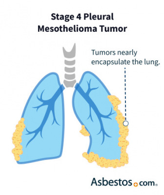 Stage 4 mesothelioma tumor progression