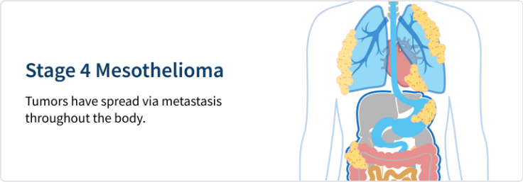 In Stage 4 Mesothelioma, tumors have spread via metastasis throughout the body.