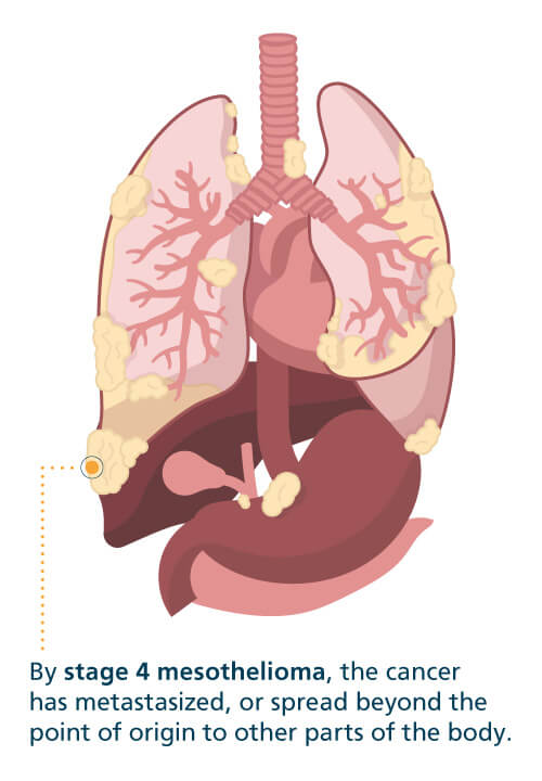 Mesothelioma What is Malignant Mesothelioma Cancer Mesothelioma What is Malignant Mesothelioma Cancer