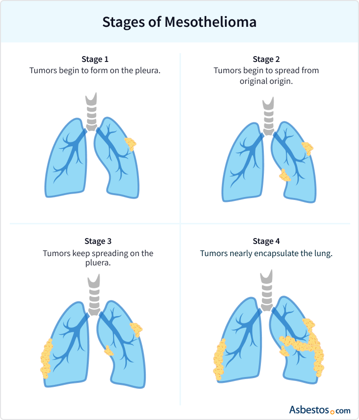 Graphic showing stages 1 through 4 of pleural mesothelioma