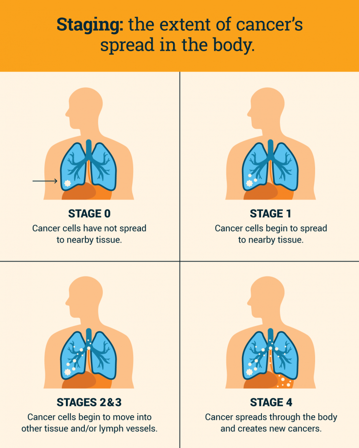 Staging definition and cancer spread by stage