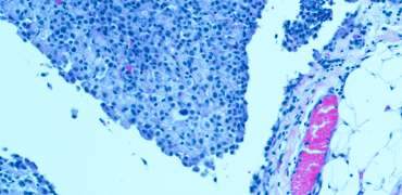 Mesothelioma cells