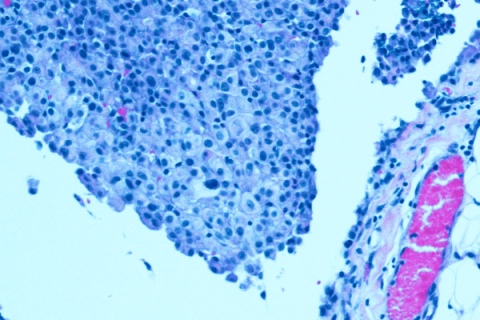 Mesothelioma cells