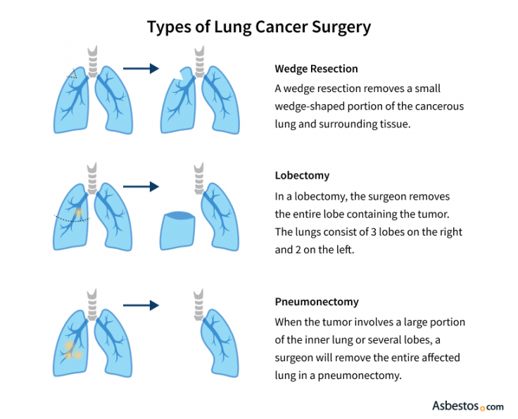 Common types of lung cancer surgery