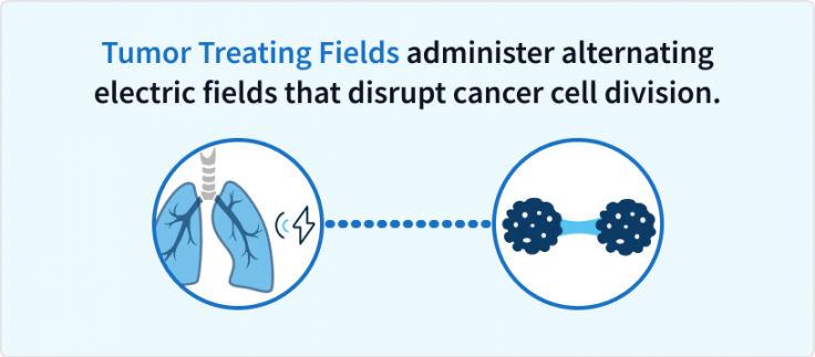 How Tumor Treating Fields works