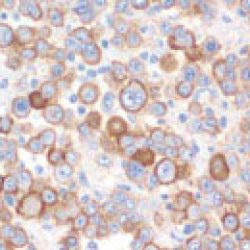 Tubulopapillary Mesothelioma Cell Sample
