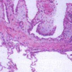 well-differentiated papillary mesothelioma