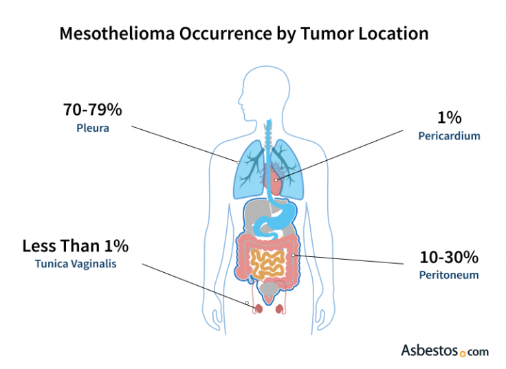 Diagram showing the types of mesothelioma as a percentage of all cases