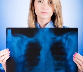 Woman holding X-ray of lung cancer