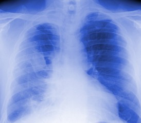 X-Ray of Lung with Mesothelioma