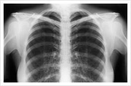 X-Ray scan of someone's chest.