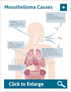 Causes Of Mesothelioma How Asbestos Causes Mesothelioma