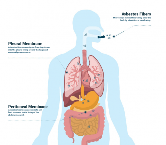 How asbestos exposure causes mesothelioma