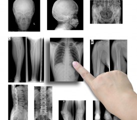 Finger pointing to chest X-ray Finger pointing to chest X-ray