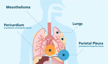 Top Mesothelioma Treatment Options for the Best Prognosis