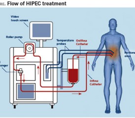 HIPEC diagram HIPEC diagram