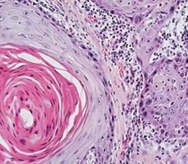 Lung cancer cells Lung cancer cells