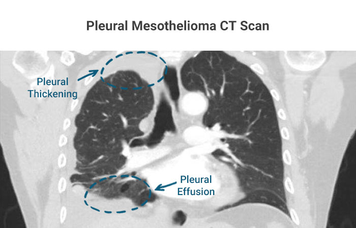 Pleural Mesothelioma CT Scan