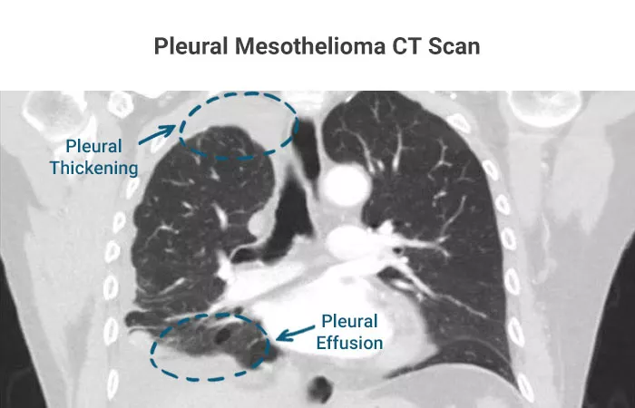 Pleural Mesothelioma CT Scan Pleural Mesothelioma CT Scan