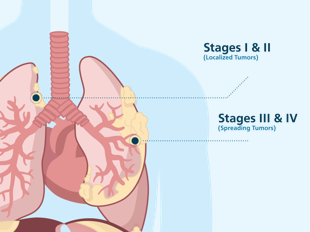 Pleural mesothelioma staging