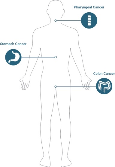 Diagram of potential asbestos cancer: pharyngeal cancer, stomach cancer, & colon cancer.