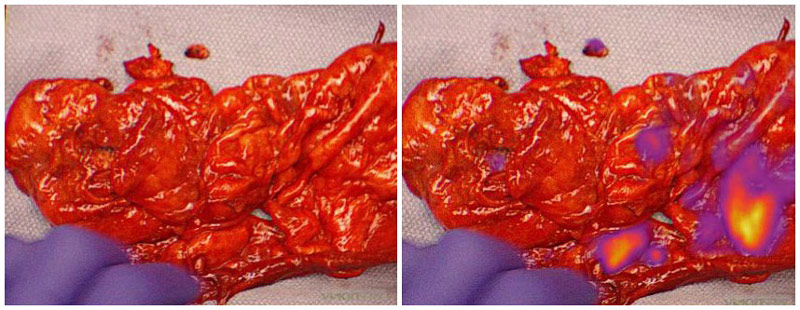 TumorGlow before and after TumorGlow before and after
