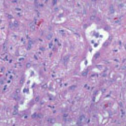 Epithelial mesothelioma cells under a microscope.