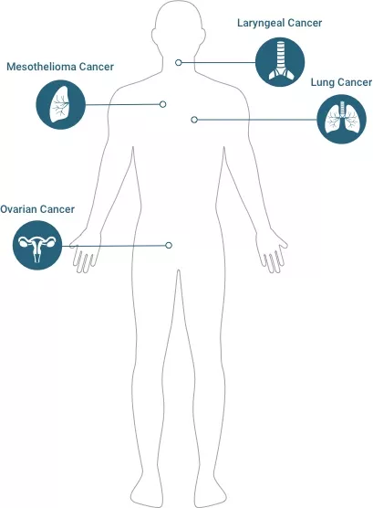 Diagram of known asbestos cancers: mesothelioma, lung cancer, laryngeal cancer, & ovarian cancer.