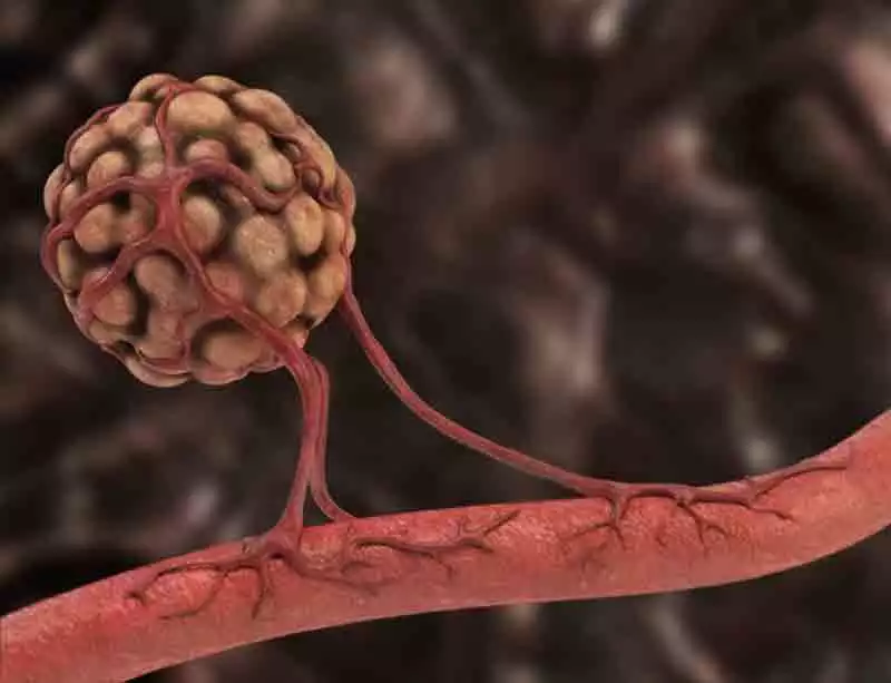 Example of angiogenesis — the formation of new blood vessels Example of angiogenesis — the formation of new blood vessels
