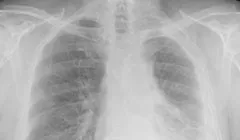 Chest x-ray