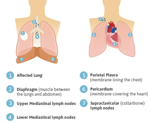 Urticaria And Hydropneumothorax As An Exceptional Cause Of Image Not Available