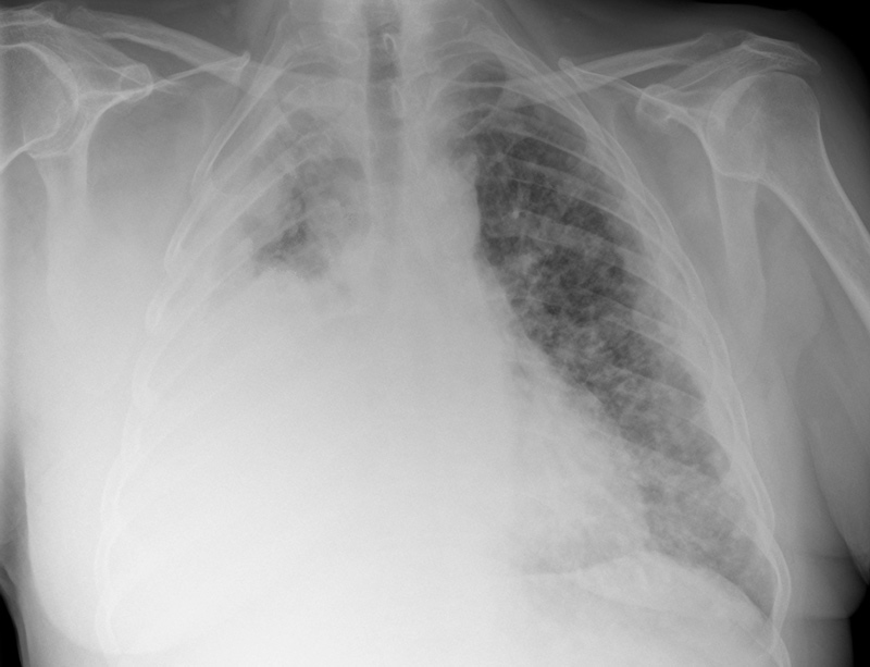 Chest X-ray showing mesothelioma Chest X-ray showing mesothelioma
