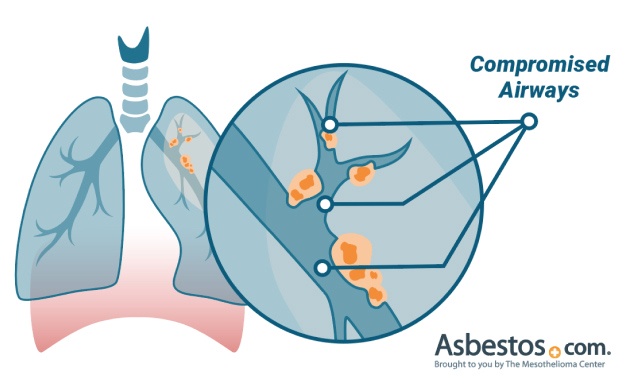 Compromised lungs