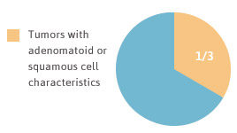 1/3 of multicystic tumors also display adenomatoid or squamous cell charactersitics