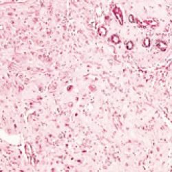 Deciduoid Mesothelioma Cell Type
