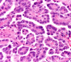 Epithelioid mesothelioma cells Epithelioid mesothelioma cells