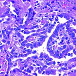 The 4 Types of Mesothelioma, Cell Types and Tailored Treatment The 4 Types of Mesothelioma, Cell Types and Tailored Treatment